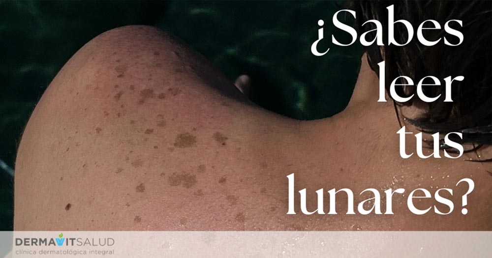 Lunares y sol: cuándo debes preocuparte (y cuándo no)